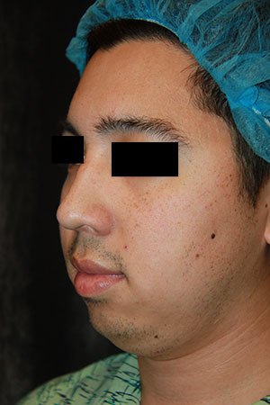 Rhinoplasty before photo - Dr. Cat Beverly Hills