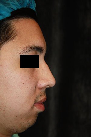 Rhinoplasty before photo - Dr. Cat Beverly Hills