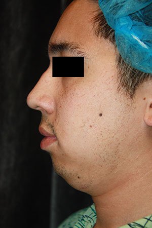 Rhinoplasty before photo - Dr. Cat Beverly Hills
