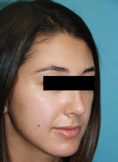 Rhinoplasty after photo - Dr. Cat Beverly Hills