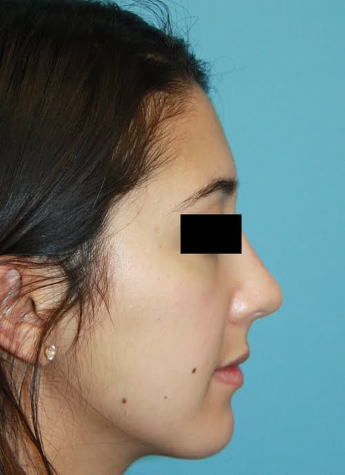 Rhinoplasty after photo - Dr. Cat Beverly Hills