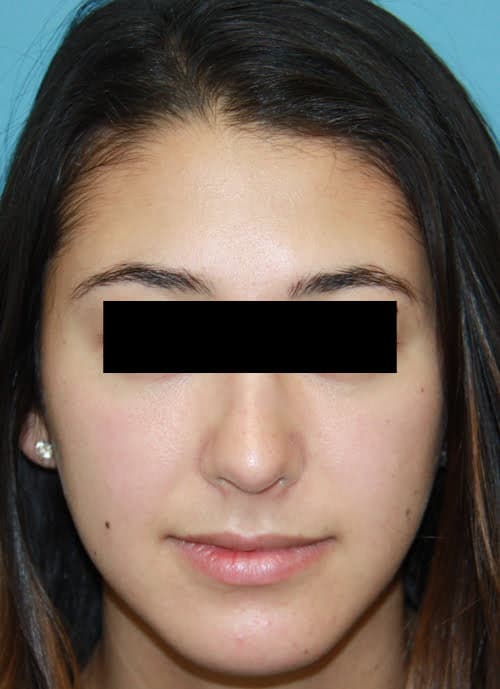Rhinoplasty after photo - Dr. Cat Beverly Hills