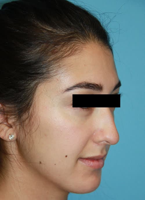 Rhinoplasty before photo - Dr. Cat Beverly Hills