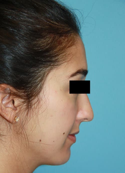 Rhinoplasty before photo - Dr. Cat Beverly Hills