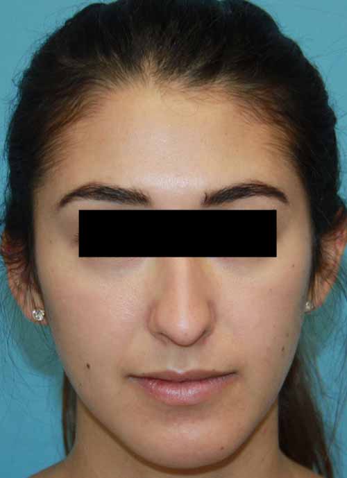 Rhinoplasty before photo - Dr. Cat Beverly Hills