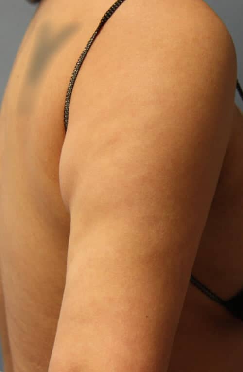 Revision Liposuction before photo - Dr. Cat Beverly Hills