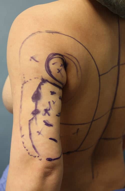 Revision Liposuction before photo - Dr. Cat Beverly Hills