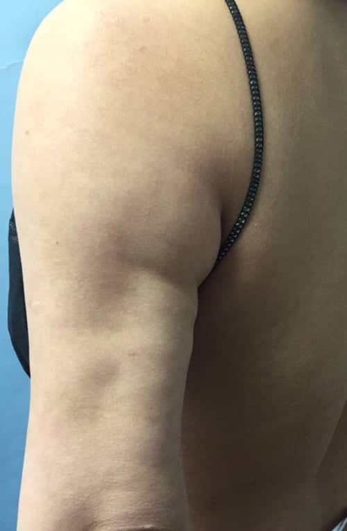Revision Liposuction before photo - Dr. Cat Beverly Hills