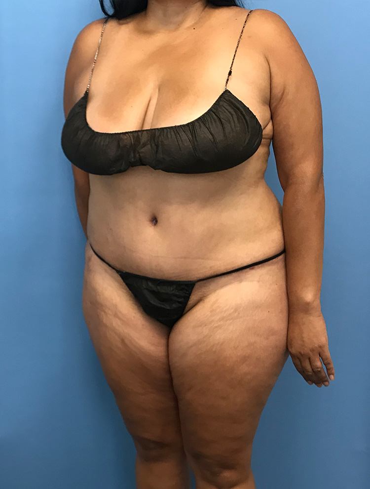 Tummy Tuck after photo angled view - Dr. Cat Beverly Hills