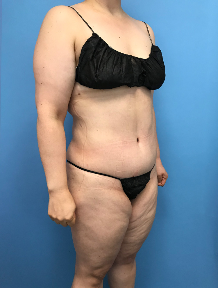 Tummy Tuck after photo angled view - Dr. Cat Beverly Hills
