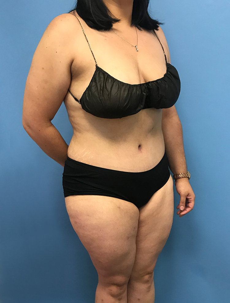 Tummy Tuck after photo angled view - Dr. Cat Beverly Hills