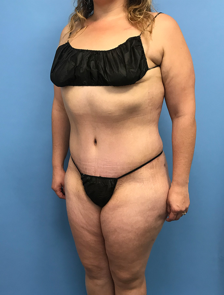 Tummy Tuck after photo angled view - Dr. Cat Beverly Hills