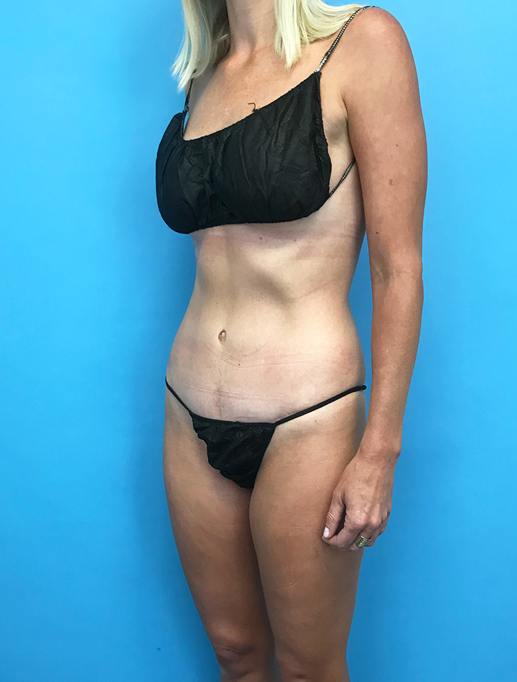 Tummy Tuck after photo angled view - Dr. Cat Beverly Hills