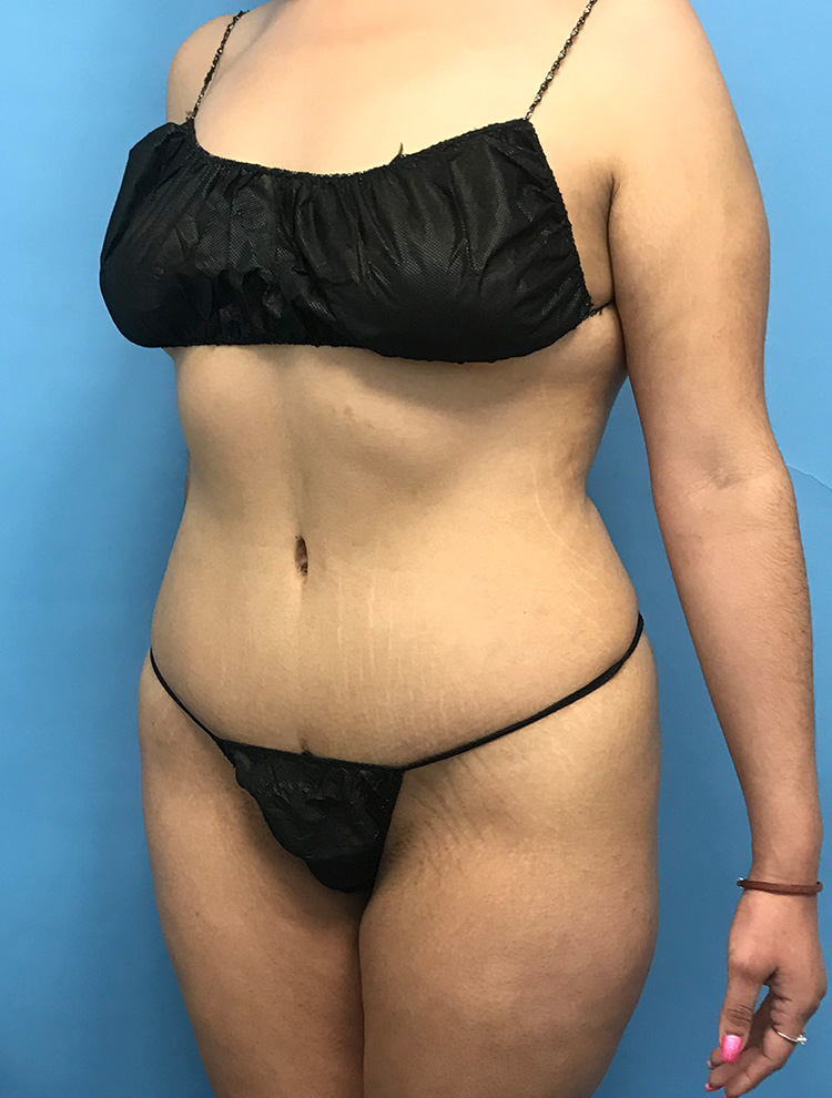 After image of a tummy tuck procedure showing the patient's side profile, emphasizing improved abdominal appearance.