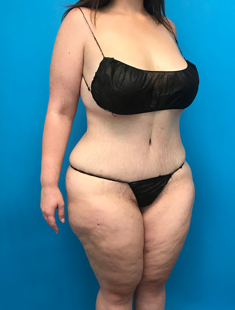 Tummy Tuck after photo angled view - Dr. Cat Beverly Hills