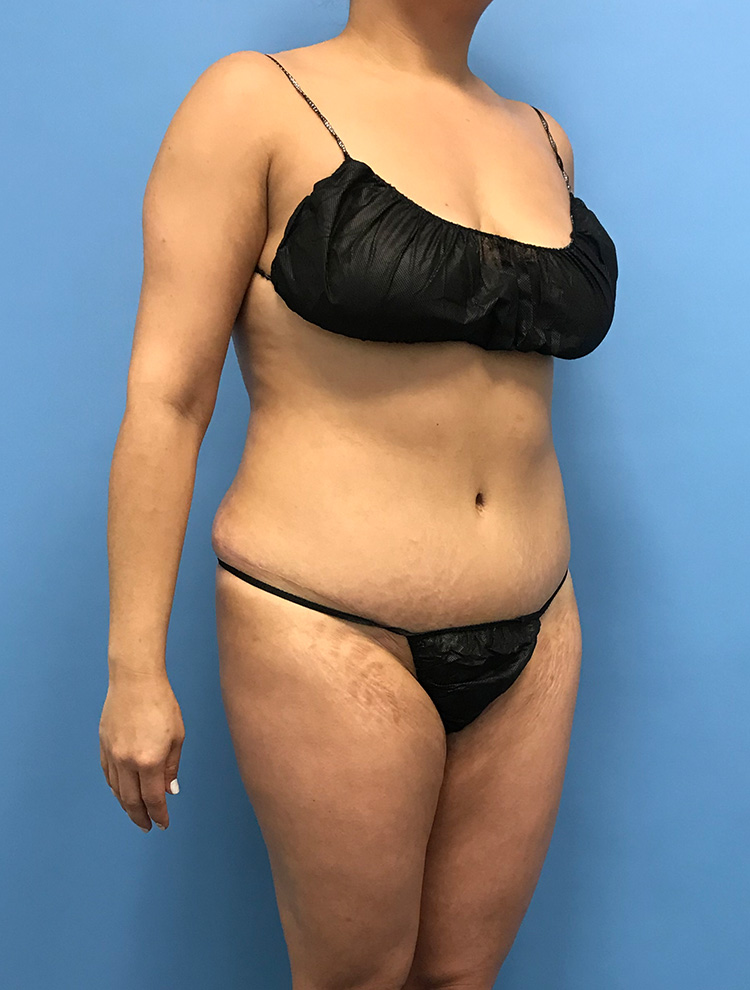 After image of a tummy tuck procedure showing the patient's side profile, emphasizing improved abdominal appearance.