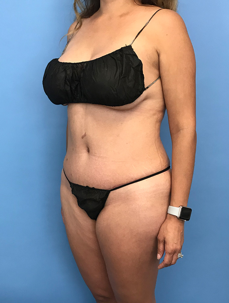 Side profile of a woman showing results after tummy tuck surgery, highlighting flatter abdomen and smoother contours.