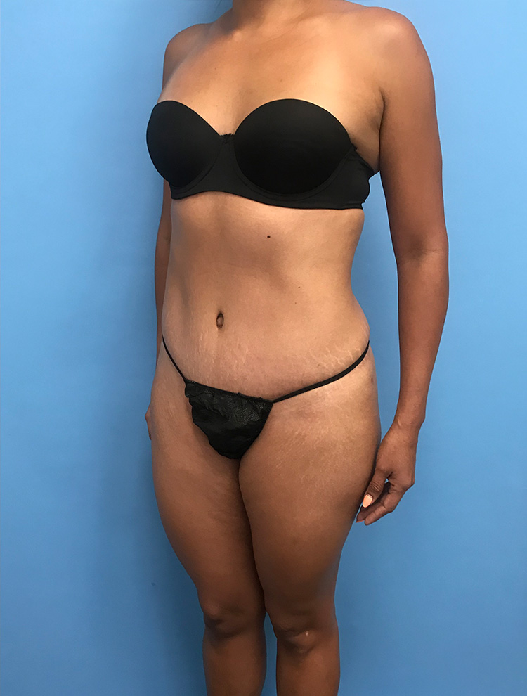 Angled view of a female patient after tummy tuck surgery showing toned abdomen and waist