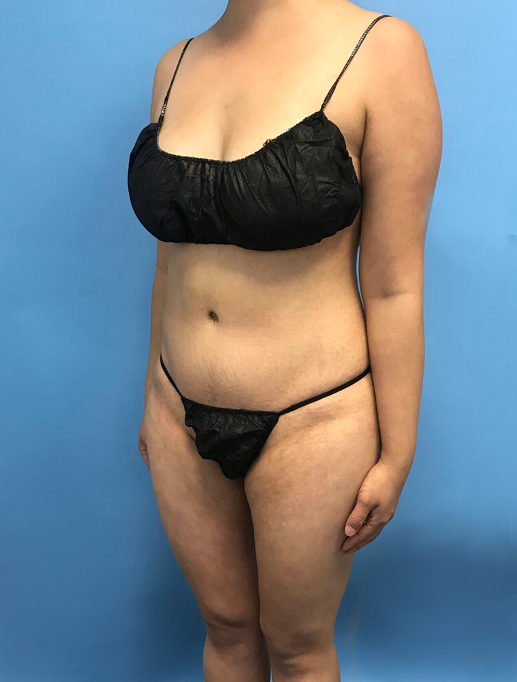 Front angled view of a woman's body after cosmetic body contouring, highlighting a toned abdomen and refined silhouette.