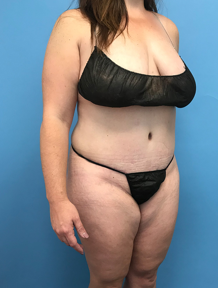 Angled side profile image of a woman's abdomen showing results after tummy tuck surgery.