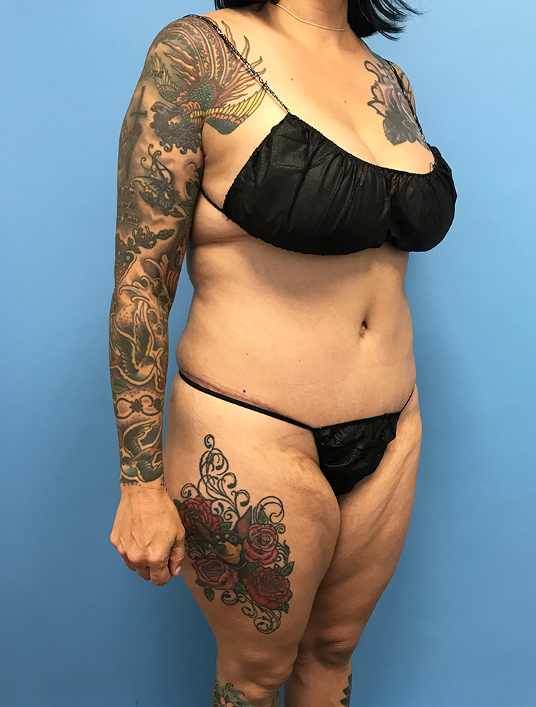 Angled side view of a female patient with tattoos after tummy tuck surgery, showing a flatter abdomen and tighter skin.