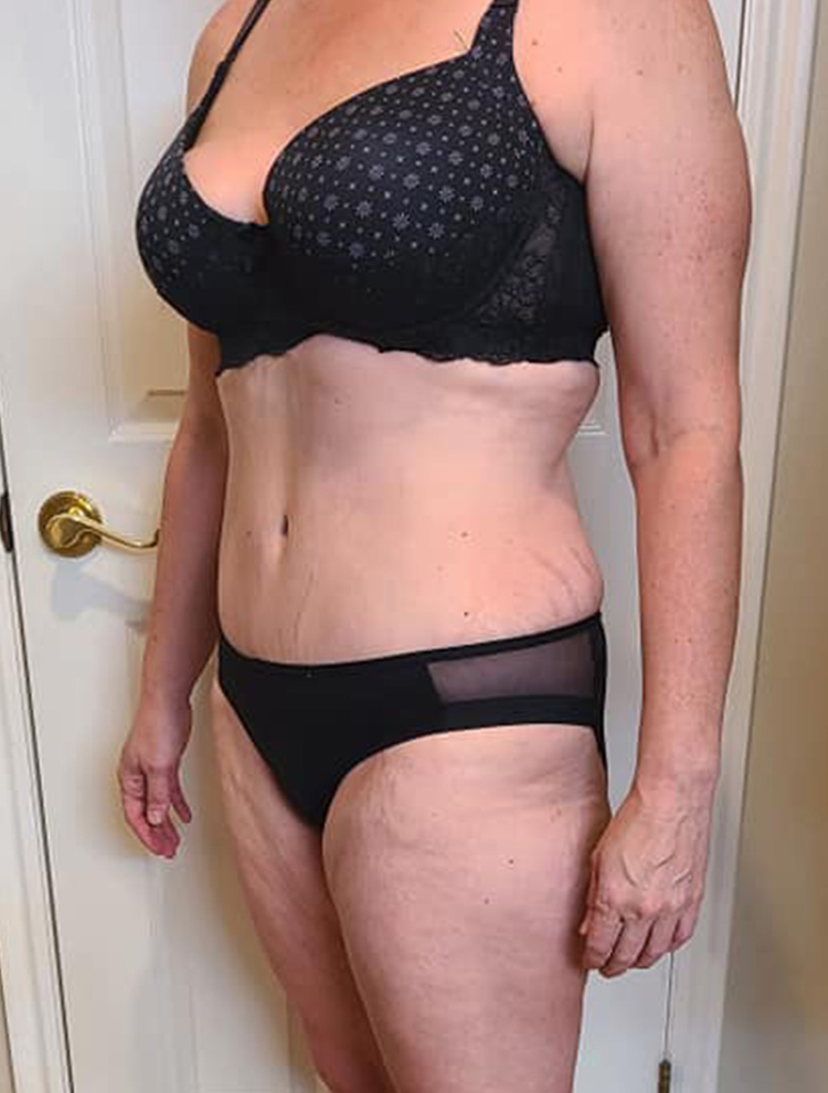 Side profile of a woman's body showcasing results after tummy tuck surgery.