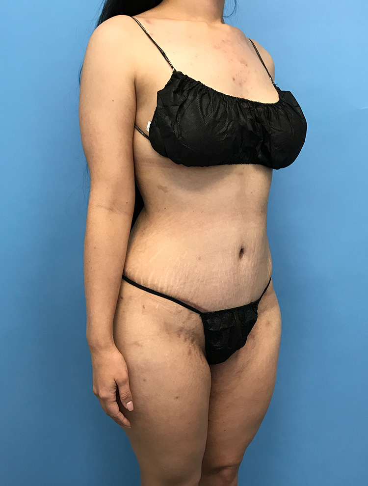 Side-angle view of a woman's abdomen showing results after tummy tuck surgery.