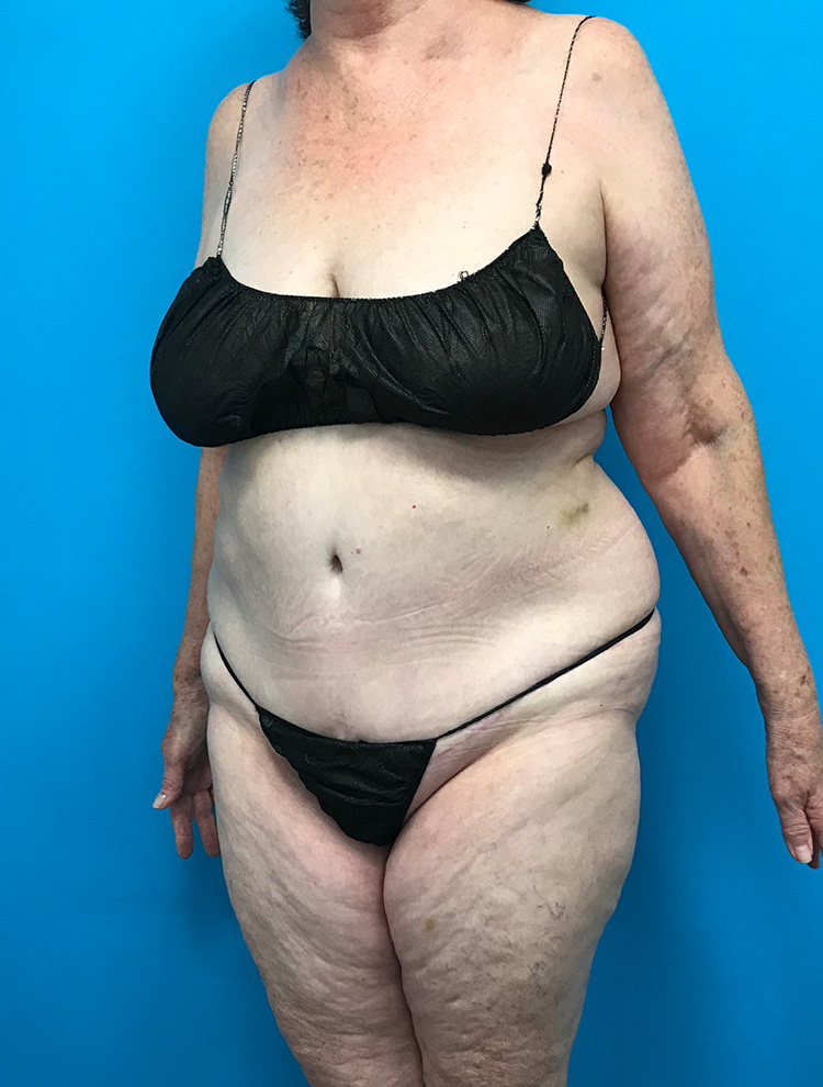 Side profile of a patient showing the abdomen before tummy tuck surgery.