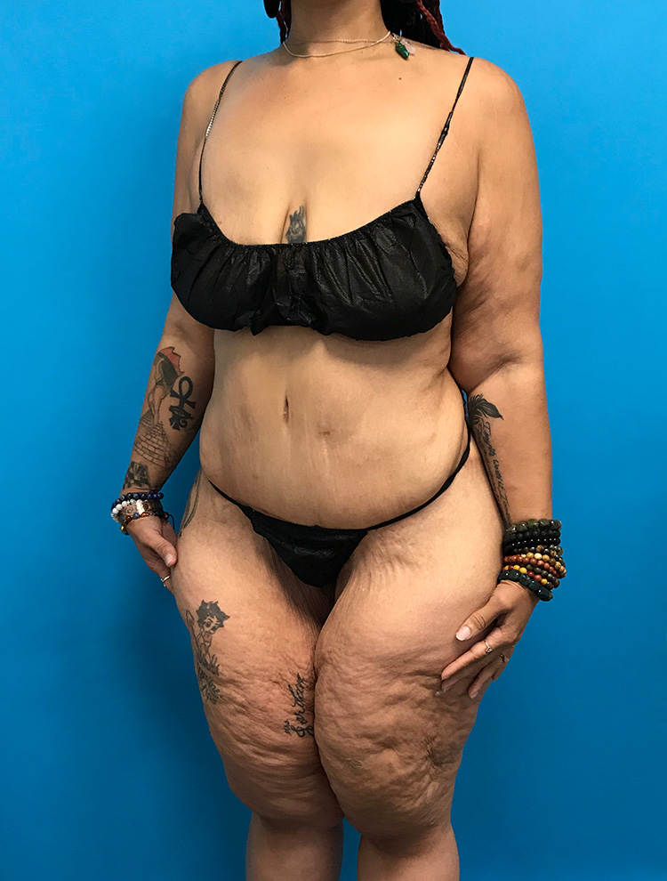 An angled side view of a female patient after tummy tuck surgery, showing reduced abdominal volume and improved waist contour.