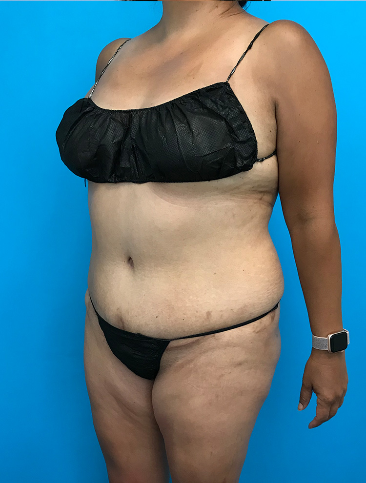 Angled view of a woman's abdomen showcasing results after tummy tuck surgery.