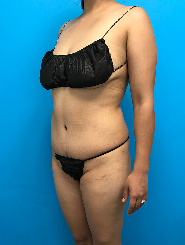 A woman shown from the side before a tummy tuck procedure, wearing black lingerie. The image shows her abdominal area and body shape before the surgery.