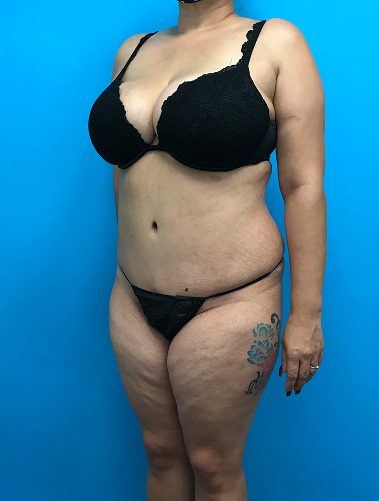 Angled view of a woman's abdomen showing the results after tummy tuck surgery.