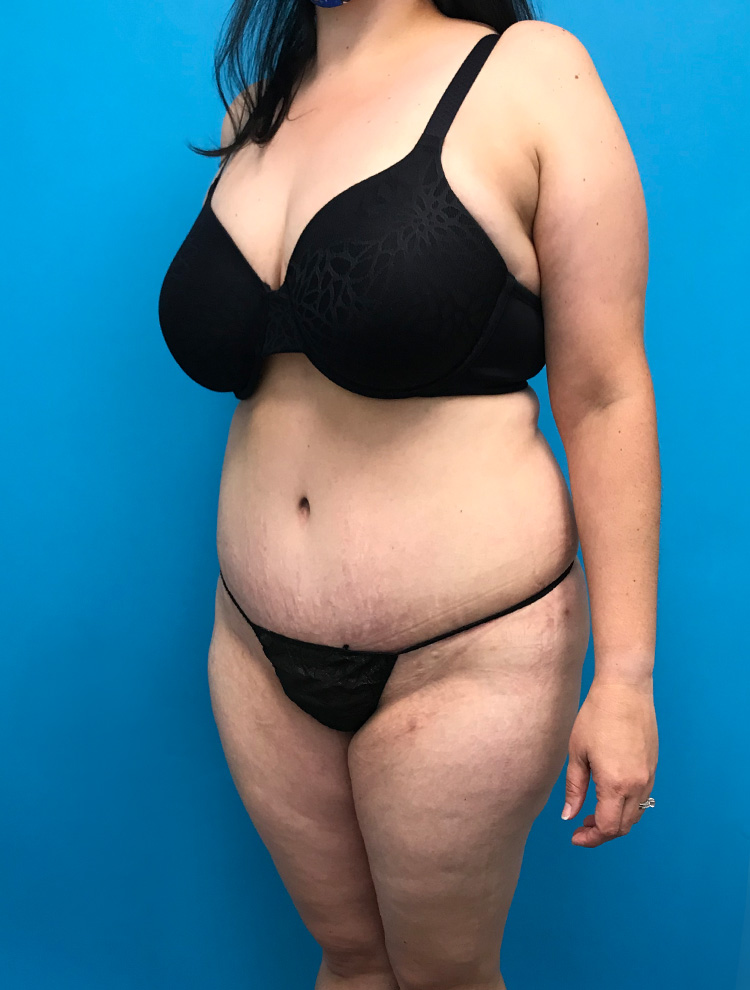 Front-angle view of a woman's abdomen showing smooth, tightened skin after tummy tuck surgery.