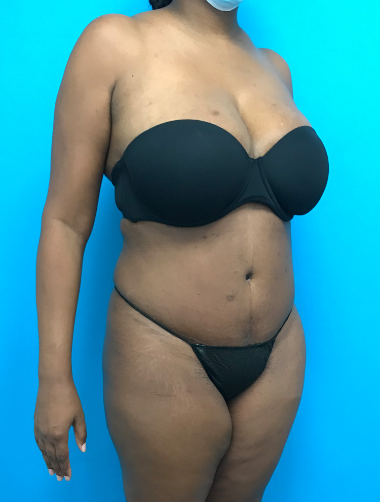 After image of a tummy tuck procedure showing the side profile of the patient.