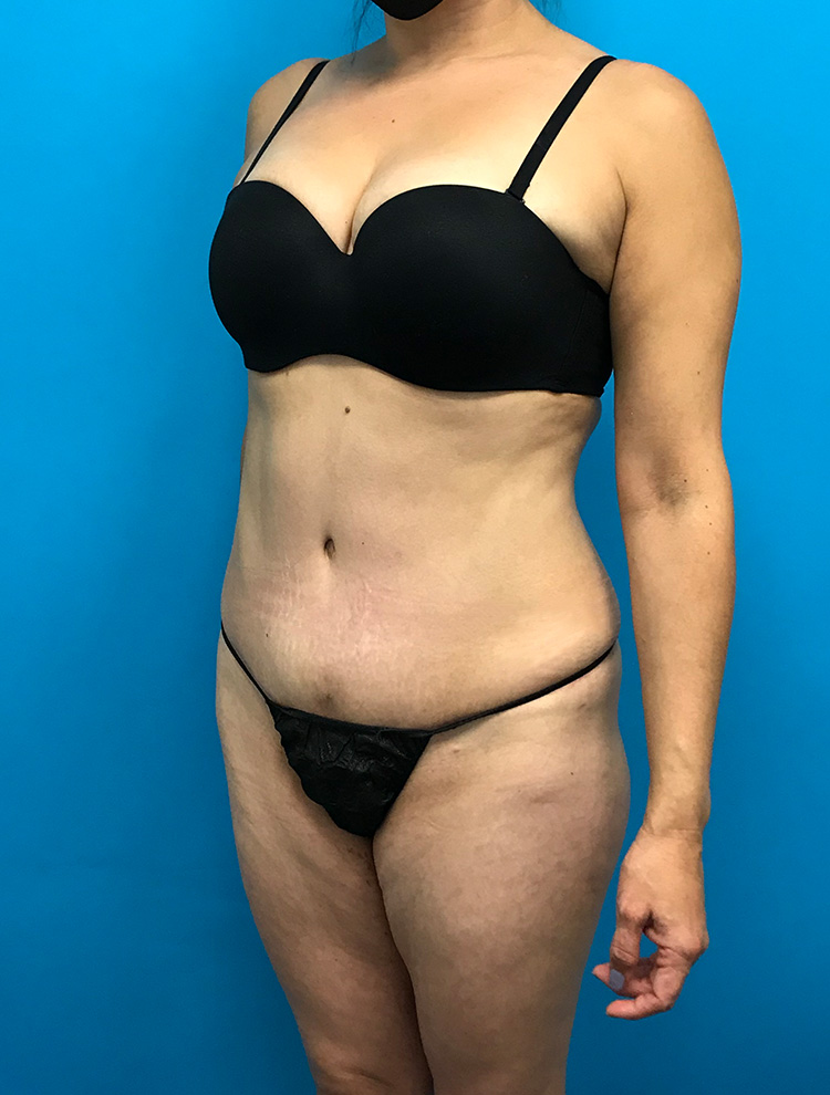 A woman shown from the side before a tummy tuck procedure, wearing black lingerie. The image shows her abdominal area and body shape before the surgery.