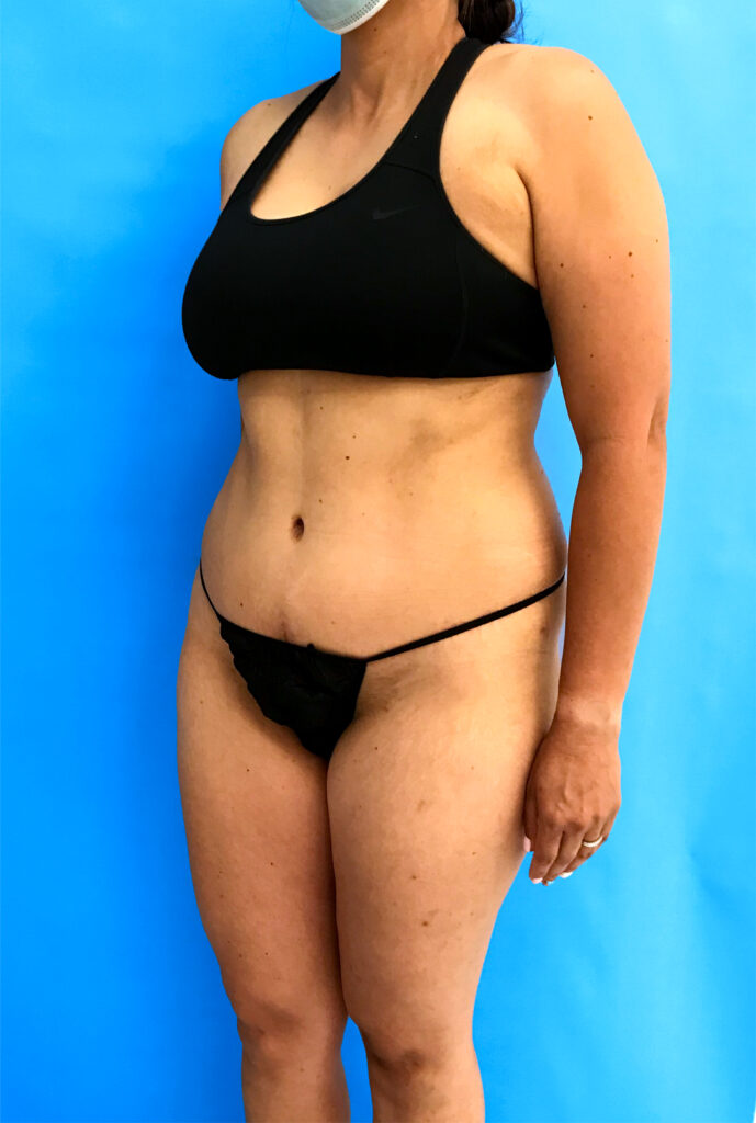 Case TTK-0789 after photo — Dr. Cat, Beverly Hills