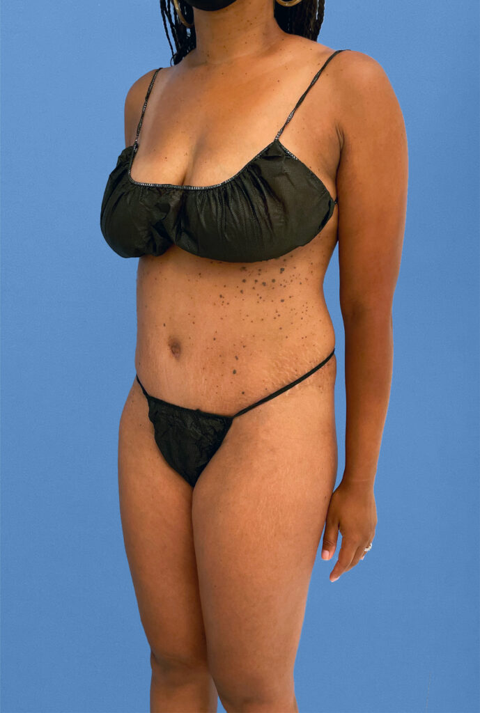 Case TTK-0833 after photo — Dr. Cat, Beverly Hills
