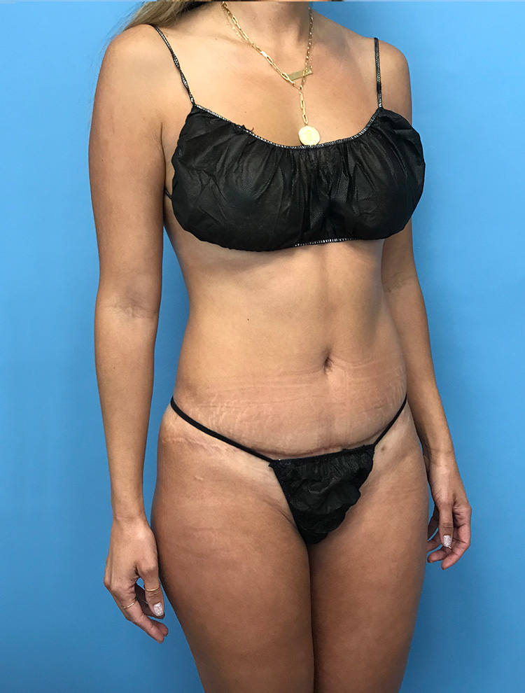 Front left-angle view of a woman's abdomen showcasing results after tummy tuck surgery.