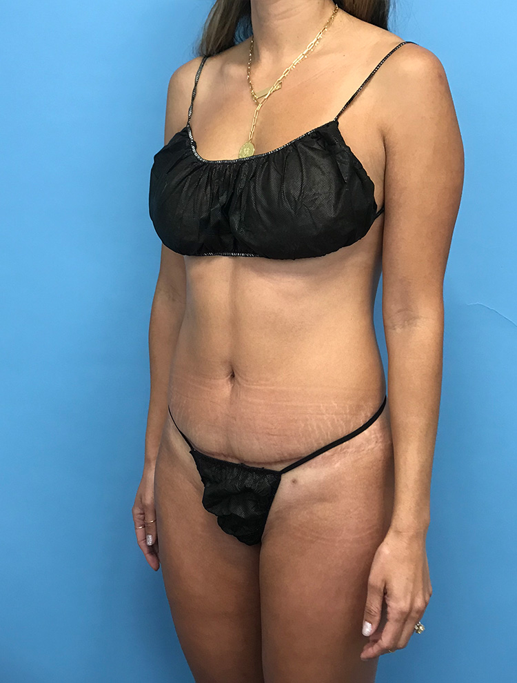 Front right-angle view of a woman's abdomen showcasing results after tummy tuck surgery.