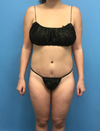 Woman's front view showing results after tummy tuck surgery