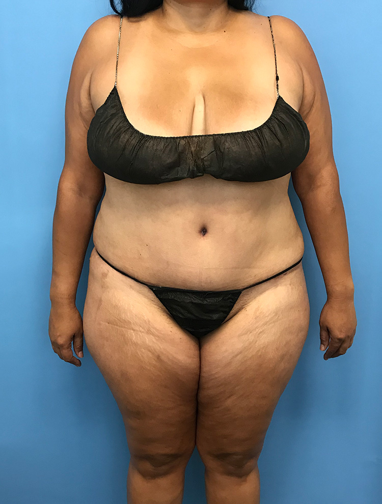 Tummy Tuck after photo front view - Dr. Cat Beverly Hills