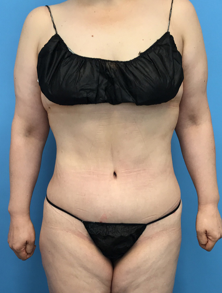 Tummy Tuck after photo front view - Dr. Cat Beverly Hills