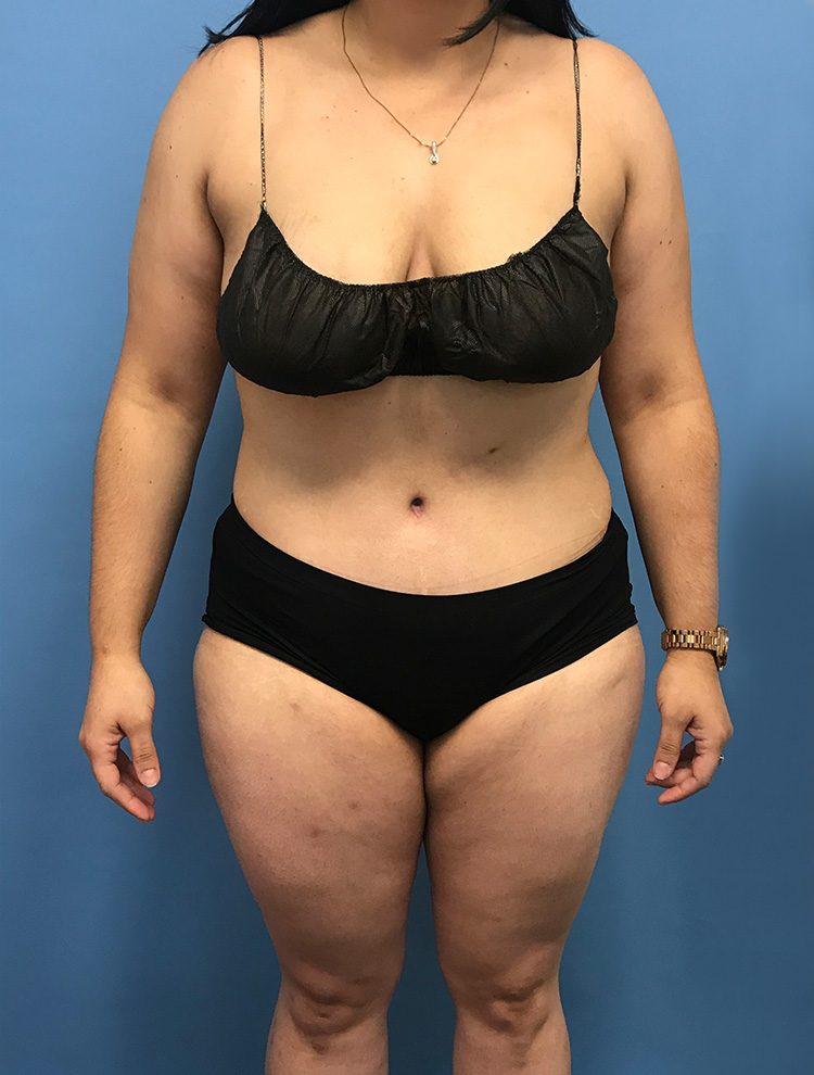 Tummy Tuck after photo front view - Dr. Cat Beverly Hills