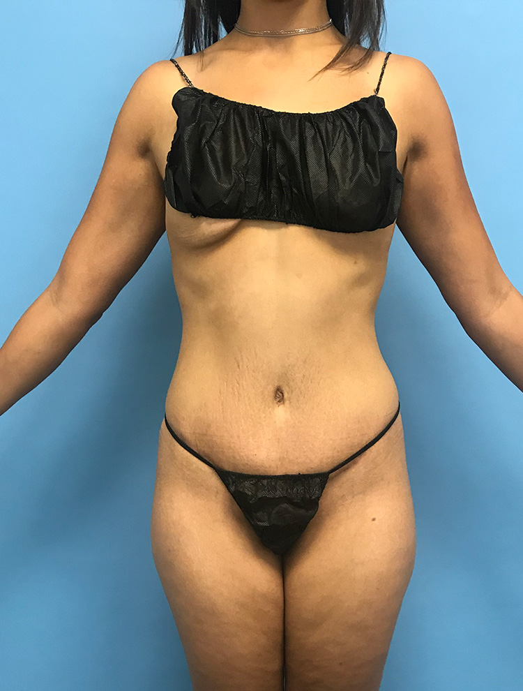Tummy Tuck after photo front view - Dr. Cat Beverly Hills