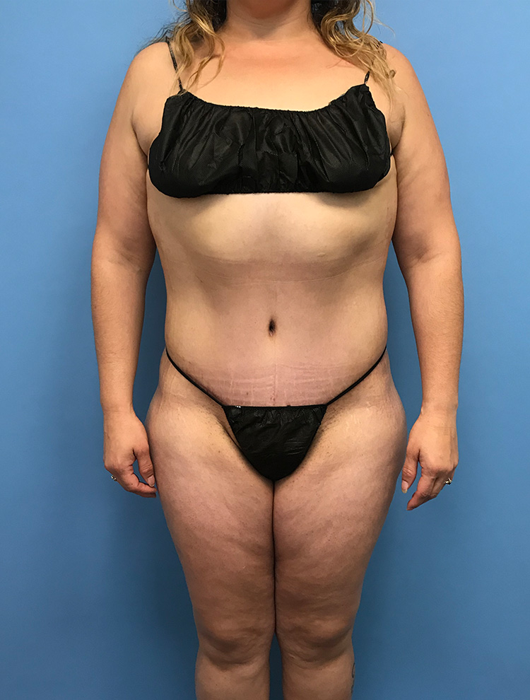 Tummy Tuck after photo front view - Dr. Cat Beverly Hills