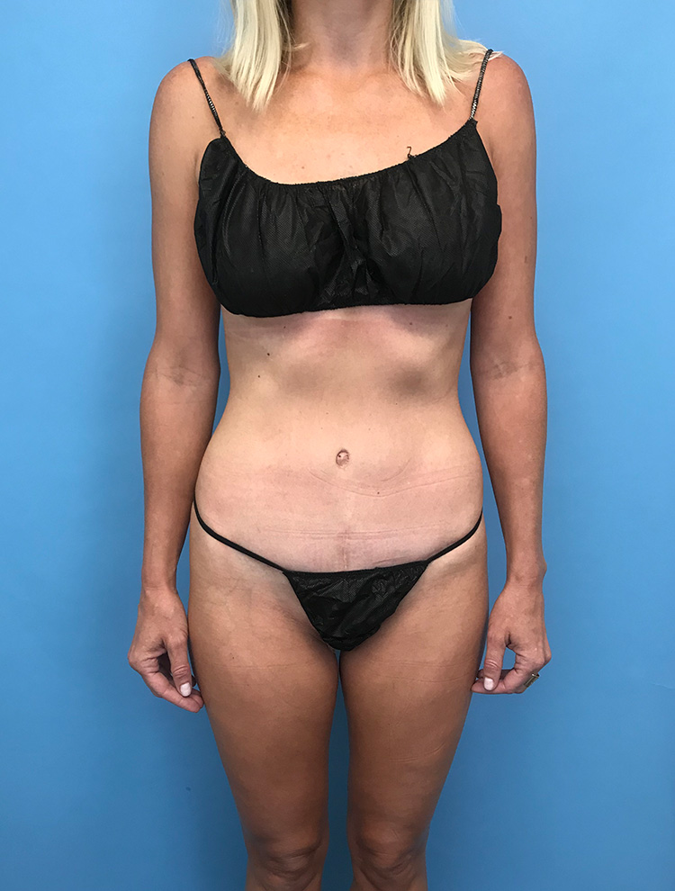 Tummy Tuck after photo front view - Dr. Cat Beverly Hills