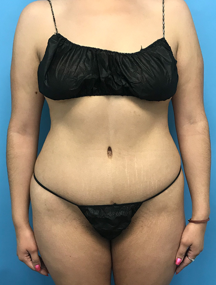 Patient showing side view after tummy tuck surgery, highlighting the improved contour of the abdomen and waist