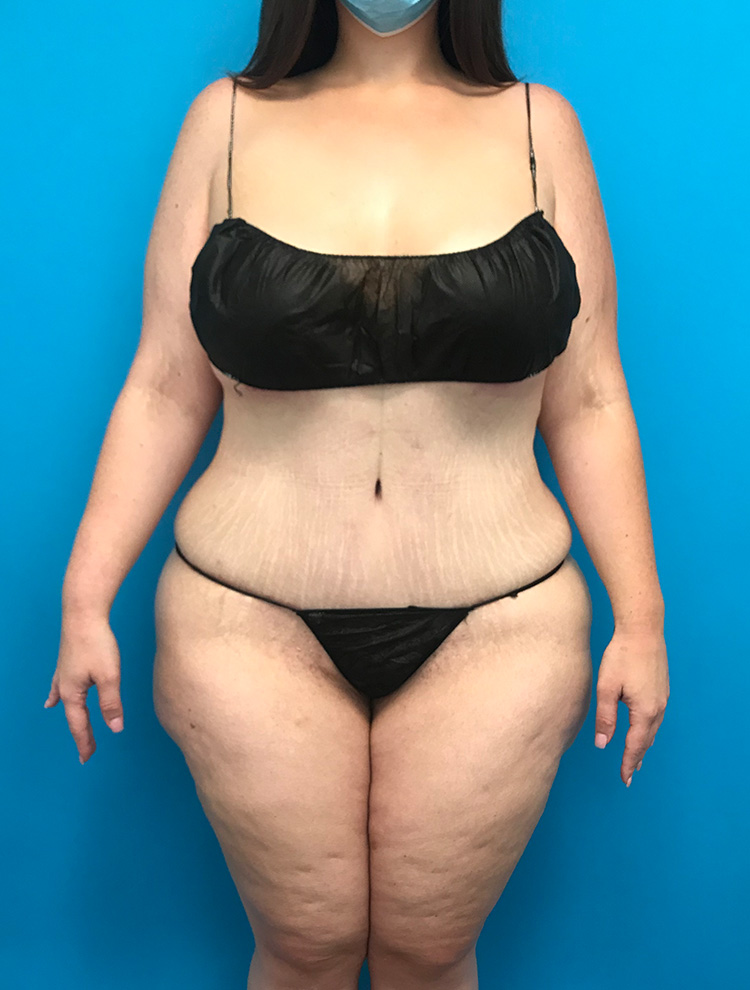 Tummy Tuck after photo front view - Dr. Cat Beverly Hills