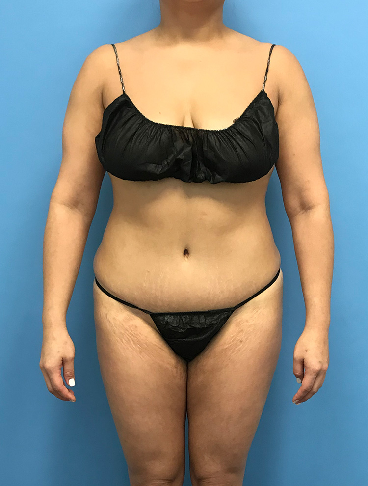 Patient showing side view after tummy tuck surgery, highlighting the improved contour of the abdomen and waist