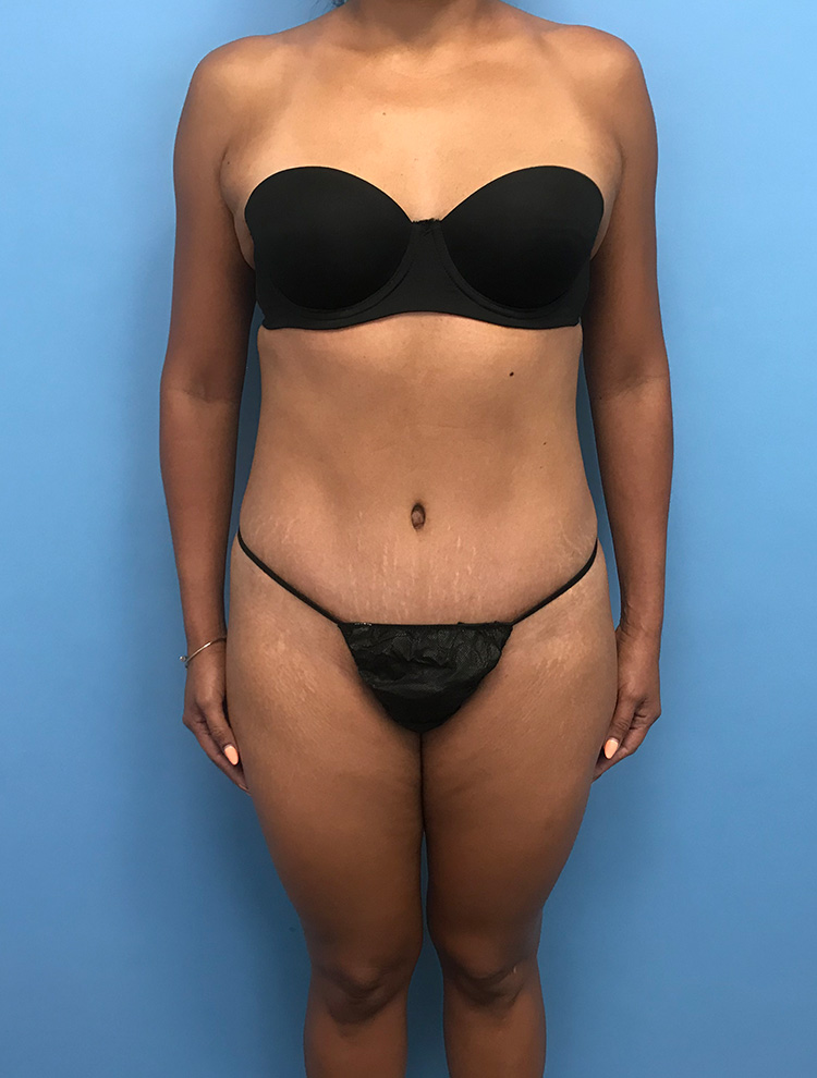 Front view of a female patient after tummy tuck surgery showing toned abdomen and waist